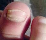 一幼兒園兒童“指甲異?！? title=