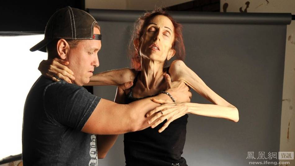 一個與厭食癥抗?fàn)?0年的37歲女人